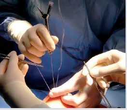 Ductoscopy and Breast Surgery