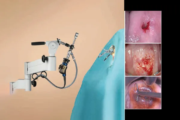 Colposcopy
