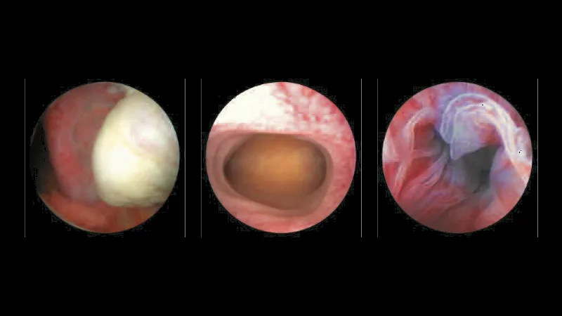 Transvaginal Endoscopy